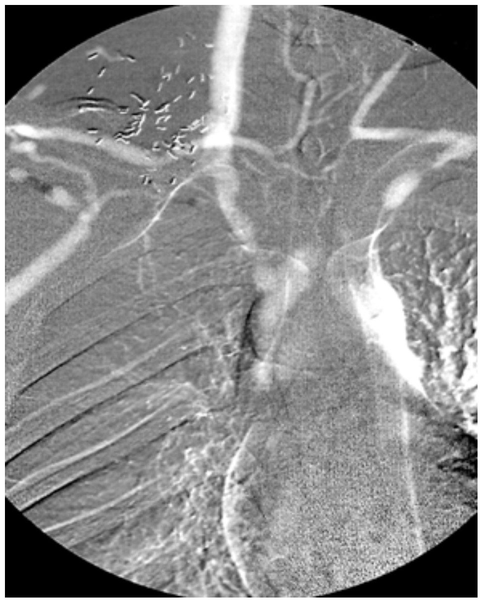 Carbon Dioxide Digital Subtraction Angiography (CO2 DSA) VDM
